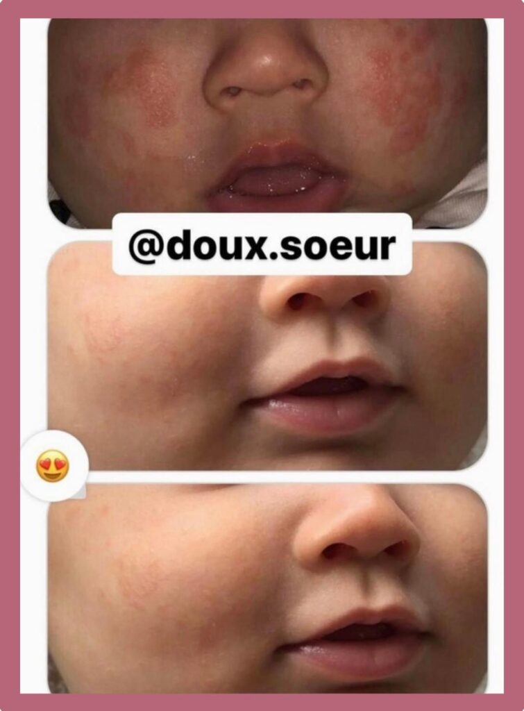 resultat de la creme tendre bebe sur l'eczema d'un bebe