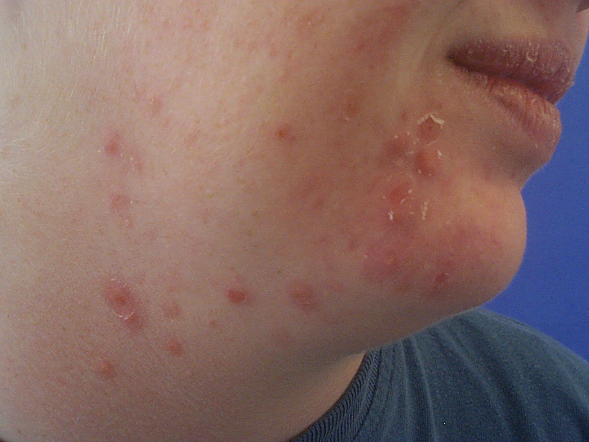 Papules sur le visage