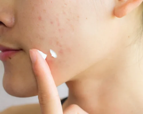 Tâche d'acné sur le visage