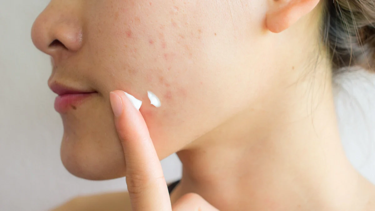 Tâche d'acné sur le visage