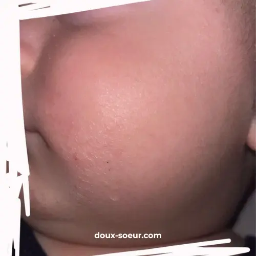 Après 2 jours d'application de la crème Tendre Bébé