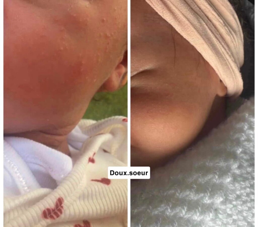 Avant et après application de la crème Tendre Bébé sur le visage