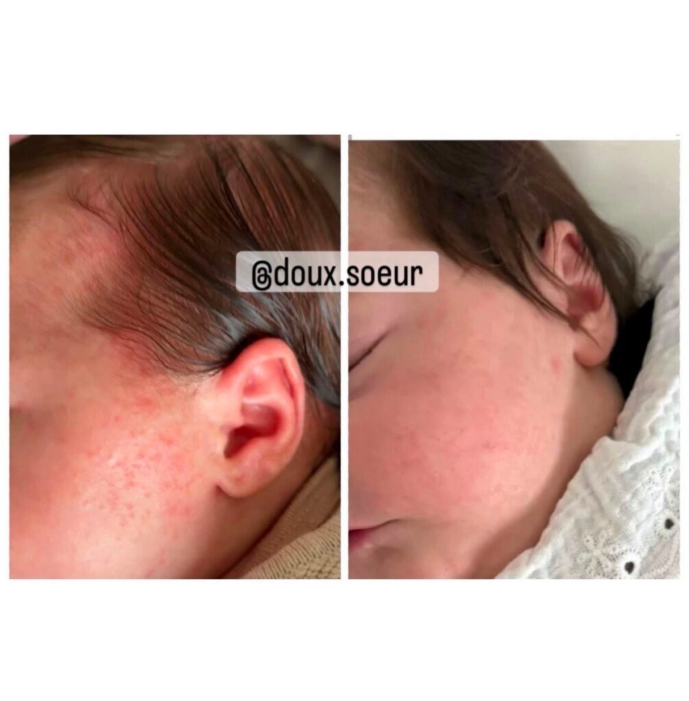 Avant et après application de la crème Tendre Bébé sur le visage et l’oreille