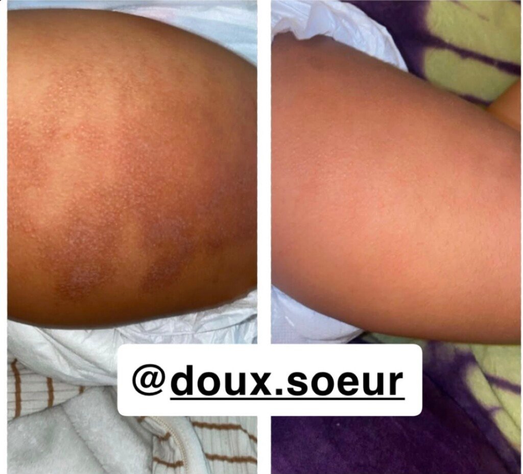 Avant et après application de la crème Tendre Bébé sur le bras