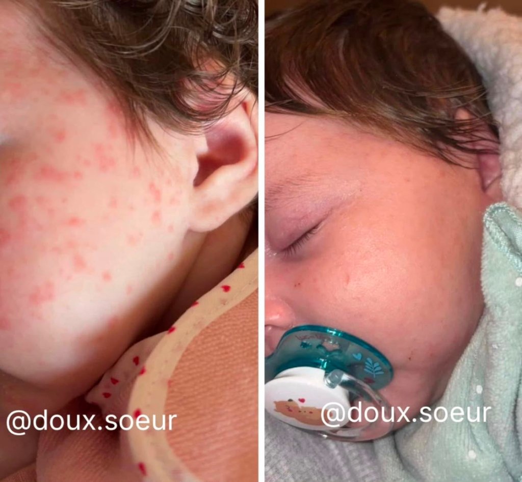 Avant/après crème Tendre Bébé : petits boutons du visage estompés