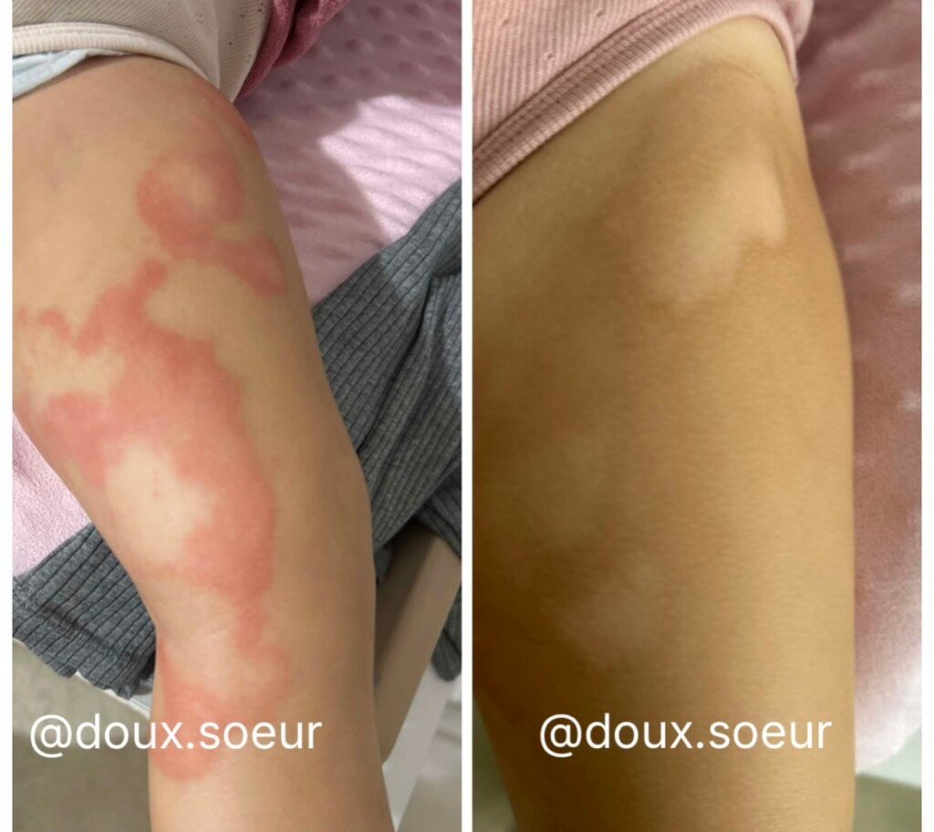 Avant et après application de la crème Tendre Bébé sur la jambe