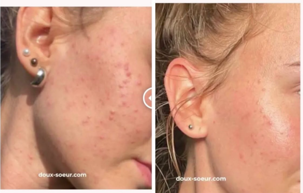 Avant/après Pack Perfection : boutons de la joue estompés