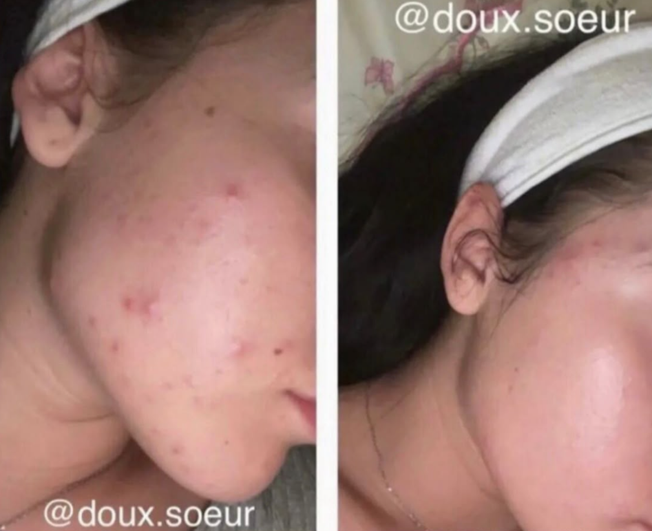 Avant/après Pack Perfection : boutons du visage estompés