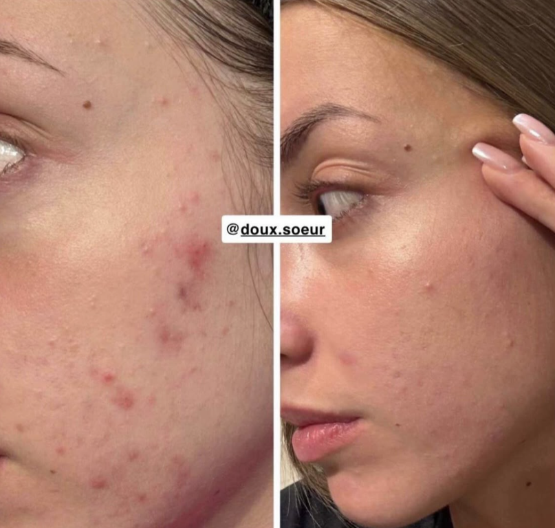Avant/après Pack Perfection : imperfections du visage estompées