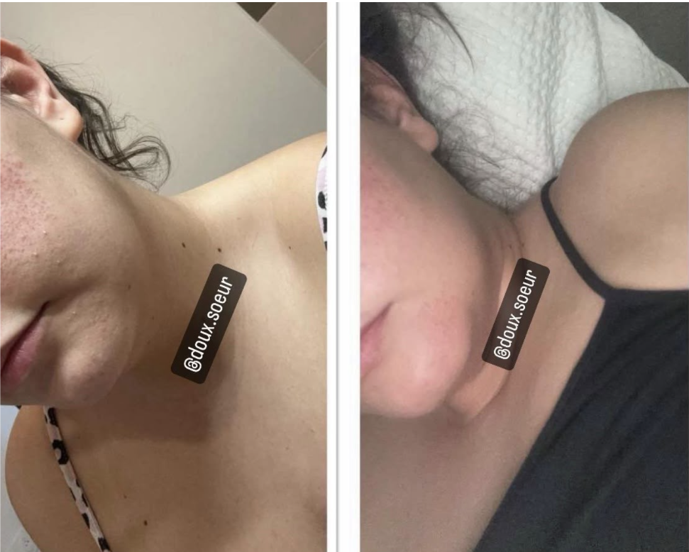 Avant/après Pack Perfection : peau du menton et du cou apaisée