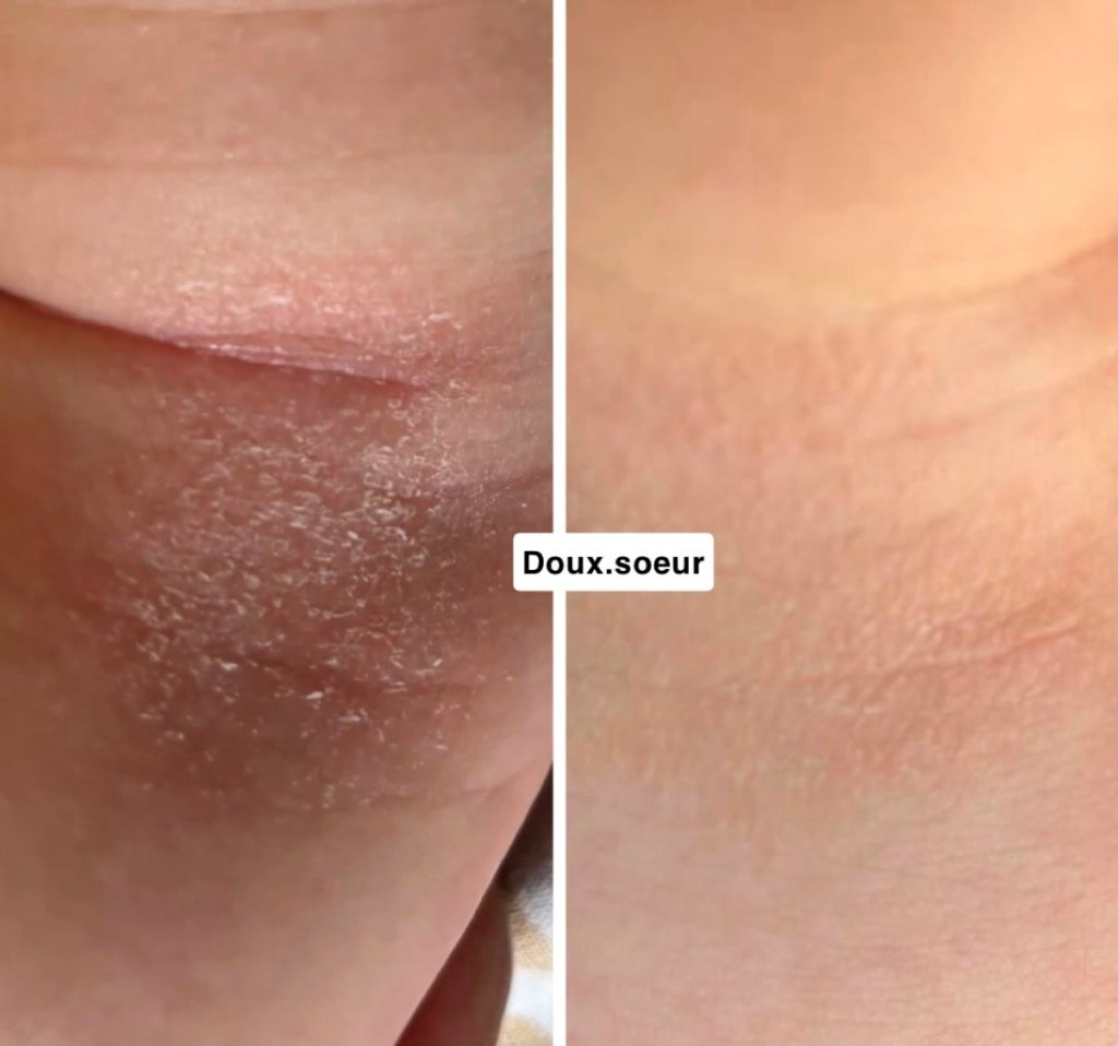 Avant/après crème Tendre Bébé : pli de peau sèche et squameuse apaisé