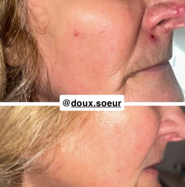 Avant/après crème Précieuse Maman : peau sèche apaisée
