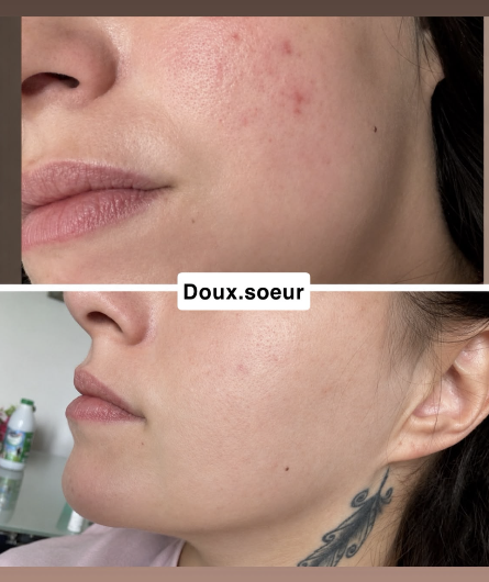 Avant/après crème Précieuse Maman : rougeurs et petits boutons estompés