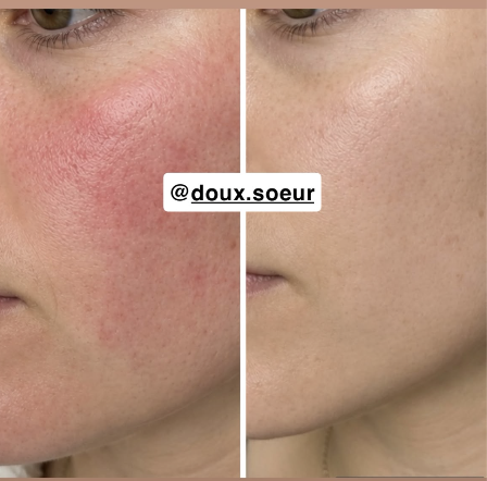 Avant/après crème Précieuse Maman : rougeurs du visage estompées