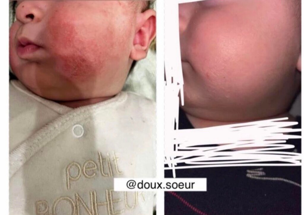 Avant et après application de la crème Tendre Bébé sur le visage
