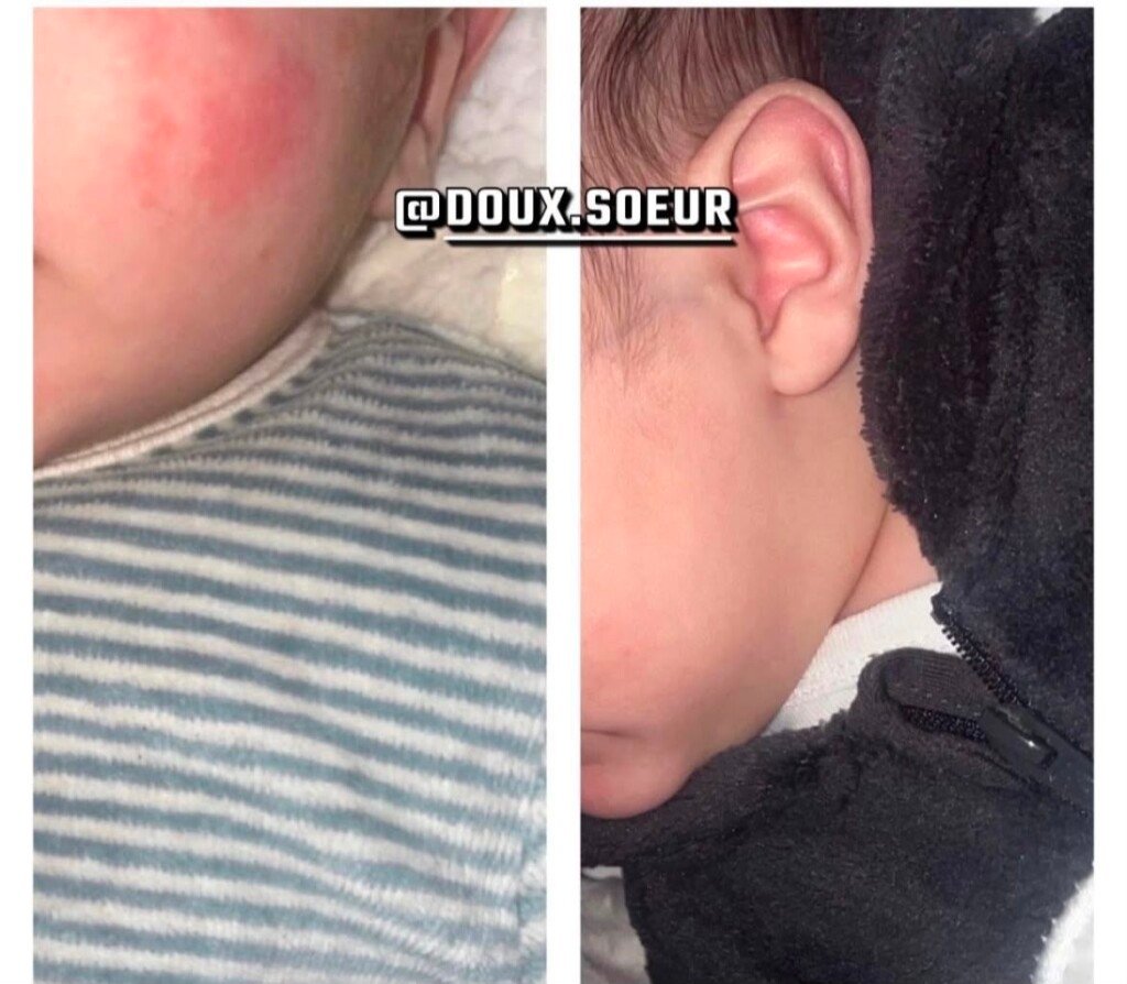 Avant et après application de la crème Tendre Bébé sur le cou
