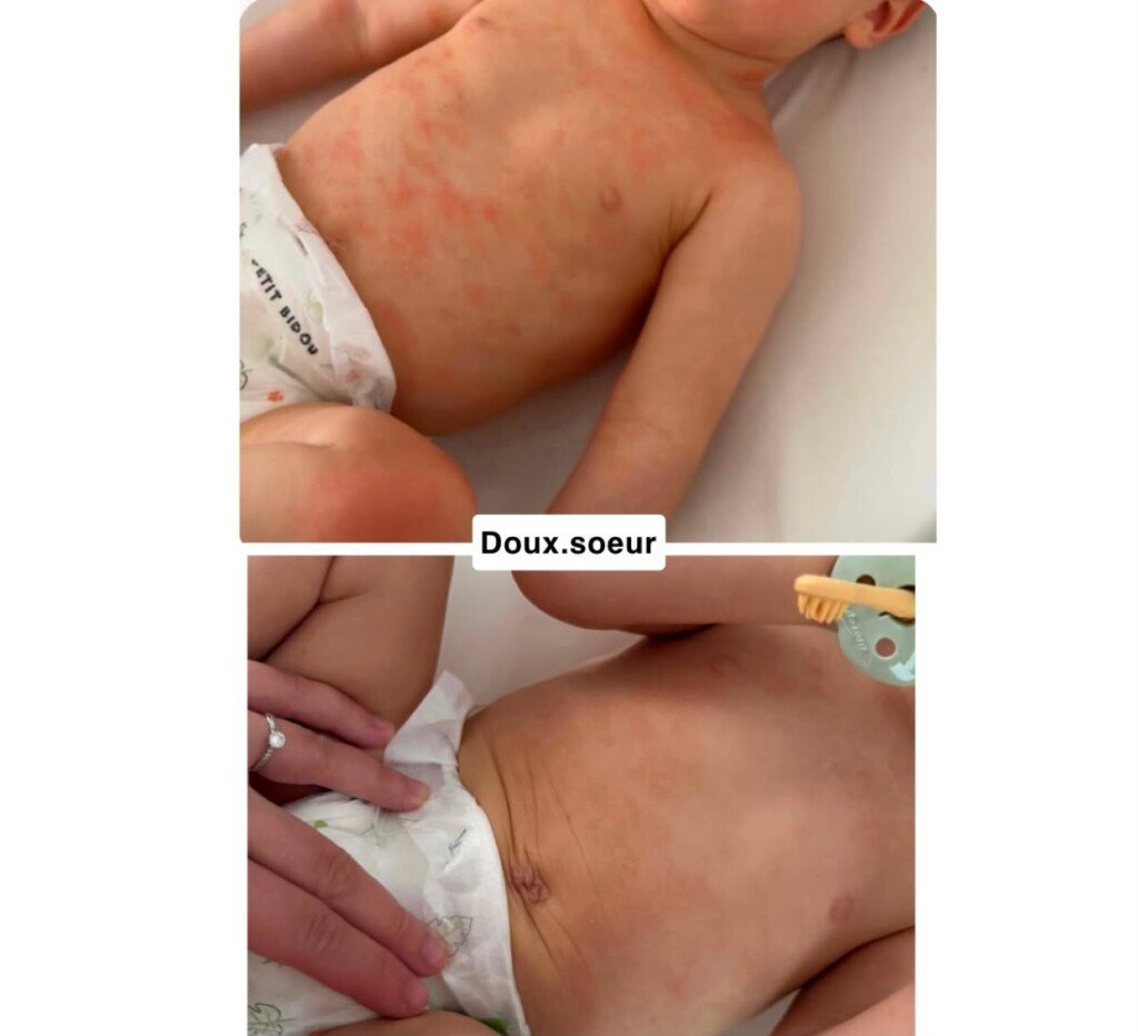Avant et après application de la crème Tendre Bébé sur le dos