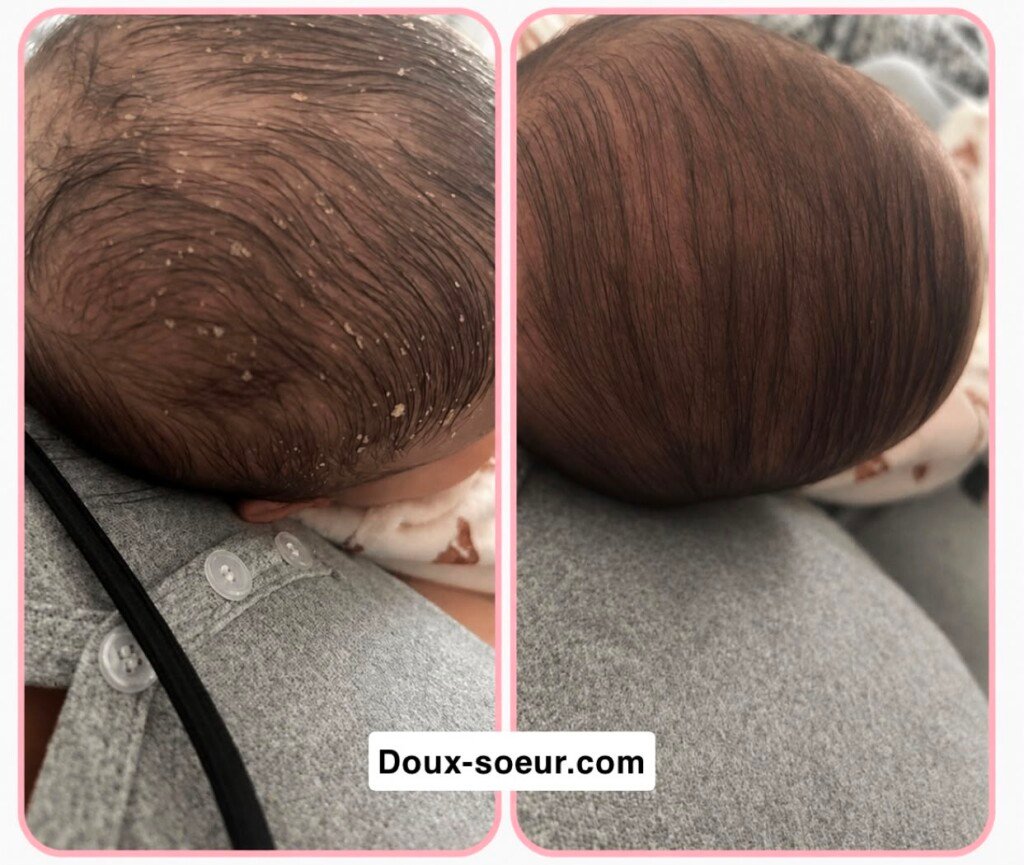 Avant et après application de la crème Tendre Bébé sur le cuir chevelu