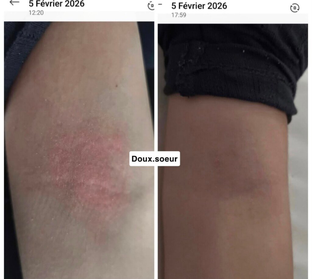 Avant et après application de la crème Tendre Bébé sur le pli du bras