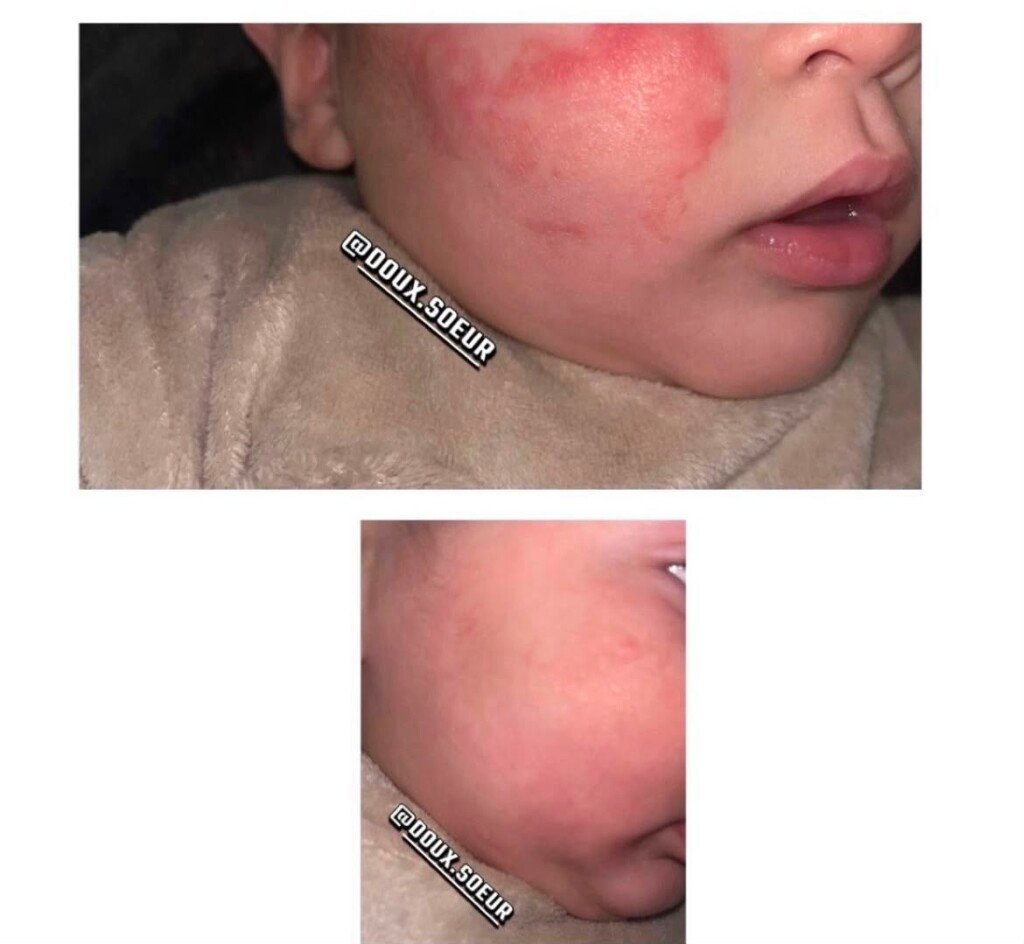 Avant et après application de la crème Tendre Bébé sur le visage