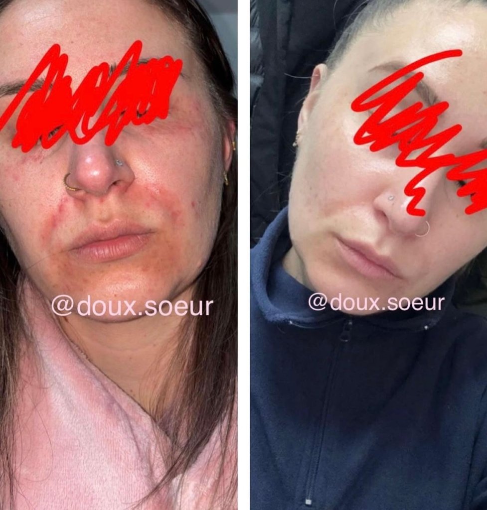 Avant/après crème Précieuse Maman : rougeurs des joues nettement estompées
